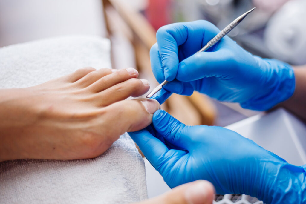 ingrown toenails